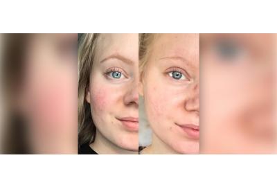 Meet Madeleine, our customer that got rid of her rash with microneedling 